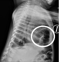 Hernia de Morgagni Bilateral